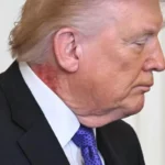 Donald Trump nyak betegség Fehér ház